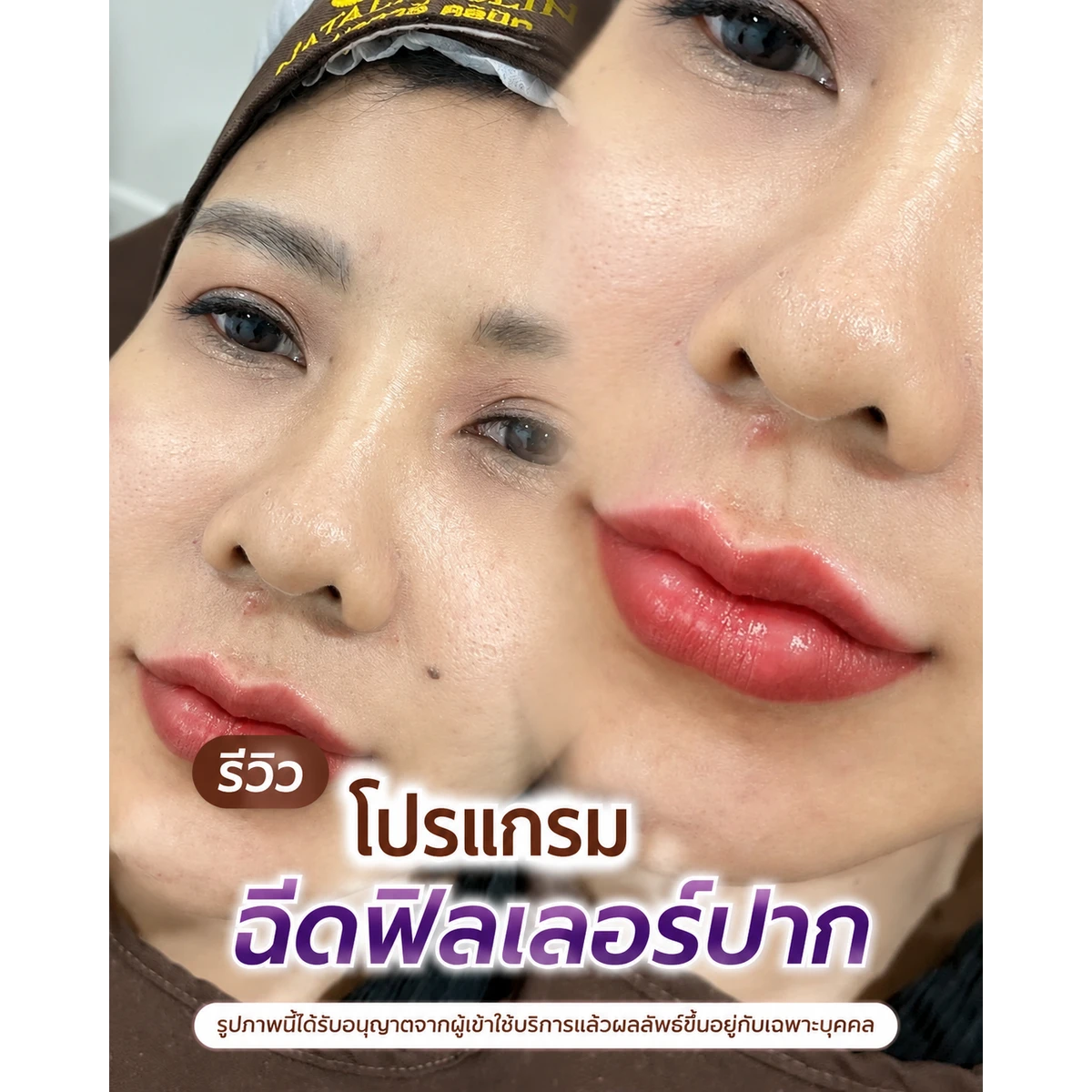 รีวิว ฟิลเลอร์ปาก ก่อน–หลัง