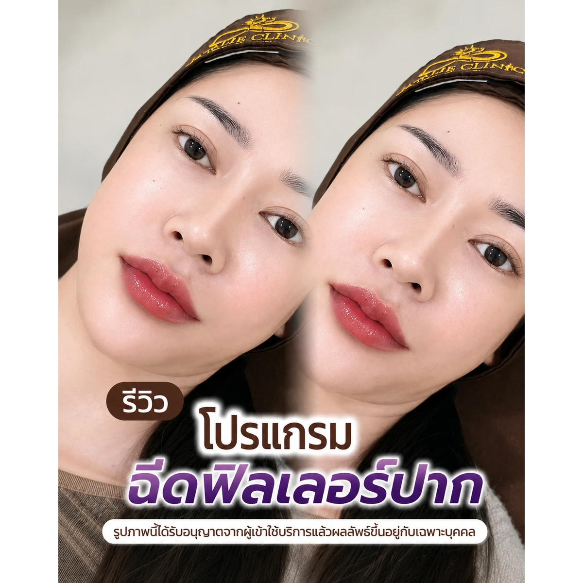 รีวิว ฟิลเลอร์ปาก ก่อน–หลัง
