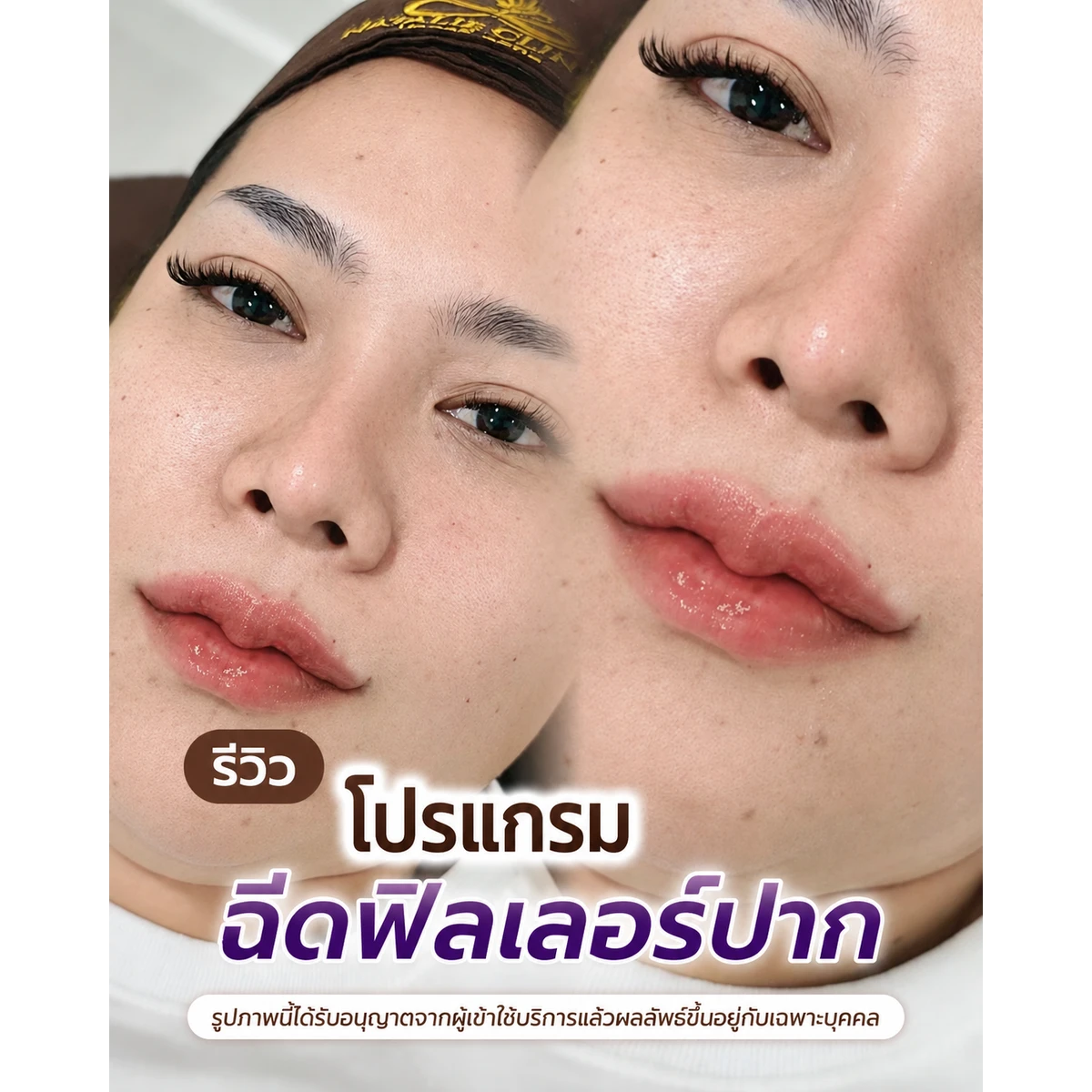 รีวิว ฟิลเลอร์ปาก ก่อน–หลัง