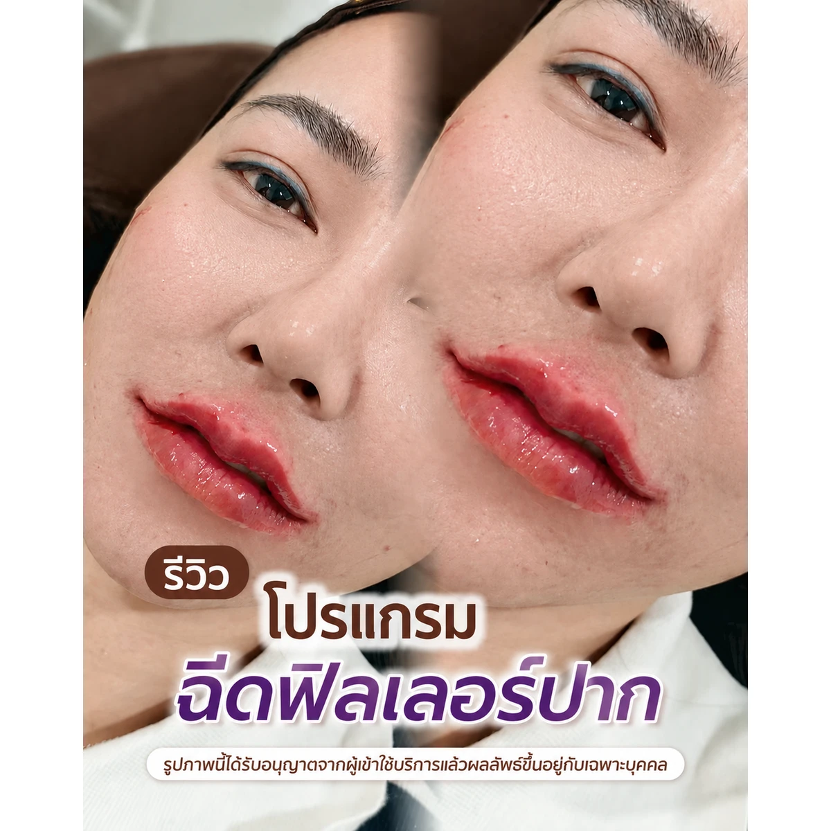 รีวิว ฟิลเลอร์ปาก ก่อน–หลัง