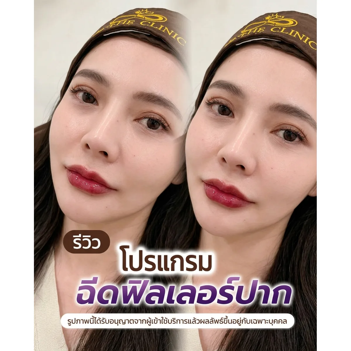 รีวิว ฟิลเลอร์ปาก ก่อน–หลัง