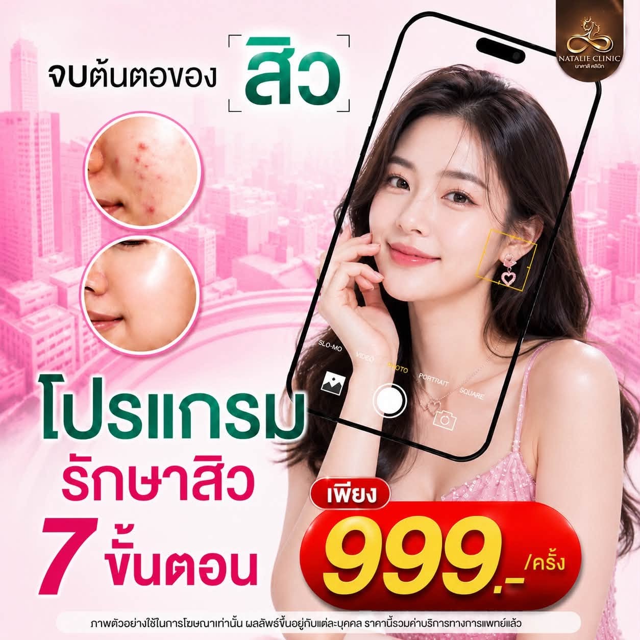โปรแกรมรักษาสิว 7 ขั้นตอน 999.-/ครั้ง