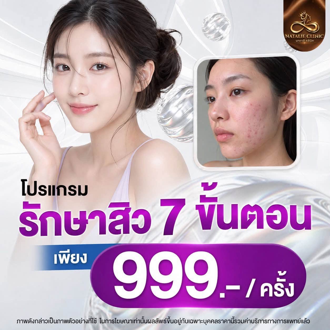 โปรแกรมรักษาสิว 7 ขั้นตอน 999.-/ครั้ง