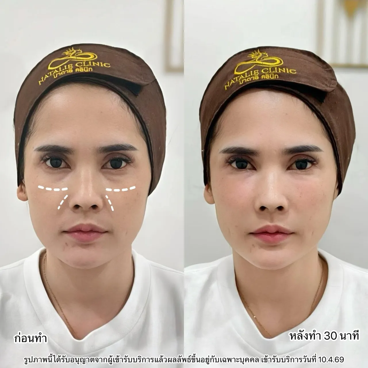 ฟิลเลอร์ใต้ตา
