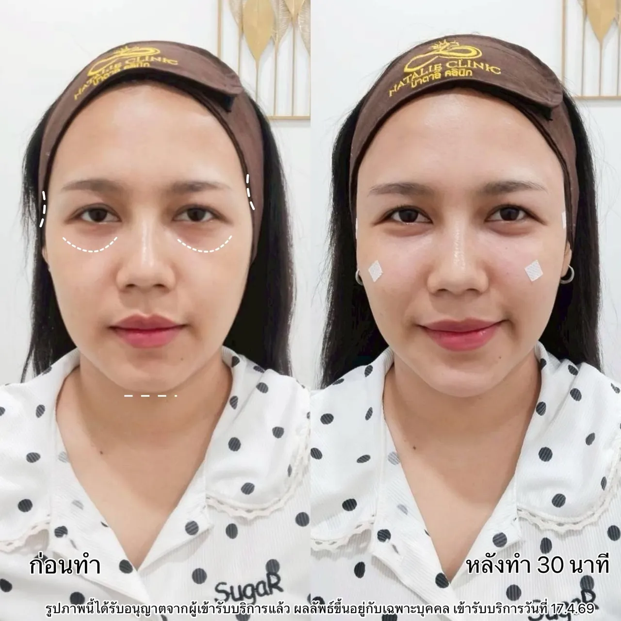 ฟิลเลอร์ใต้ตา