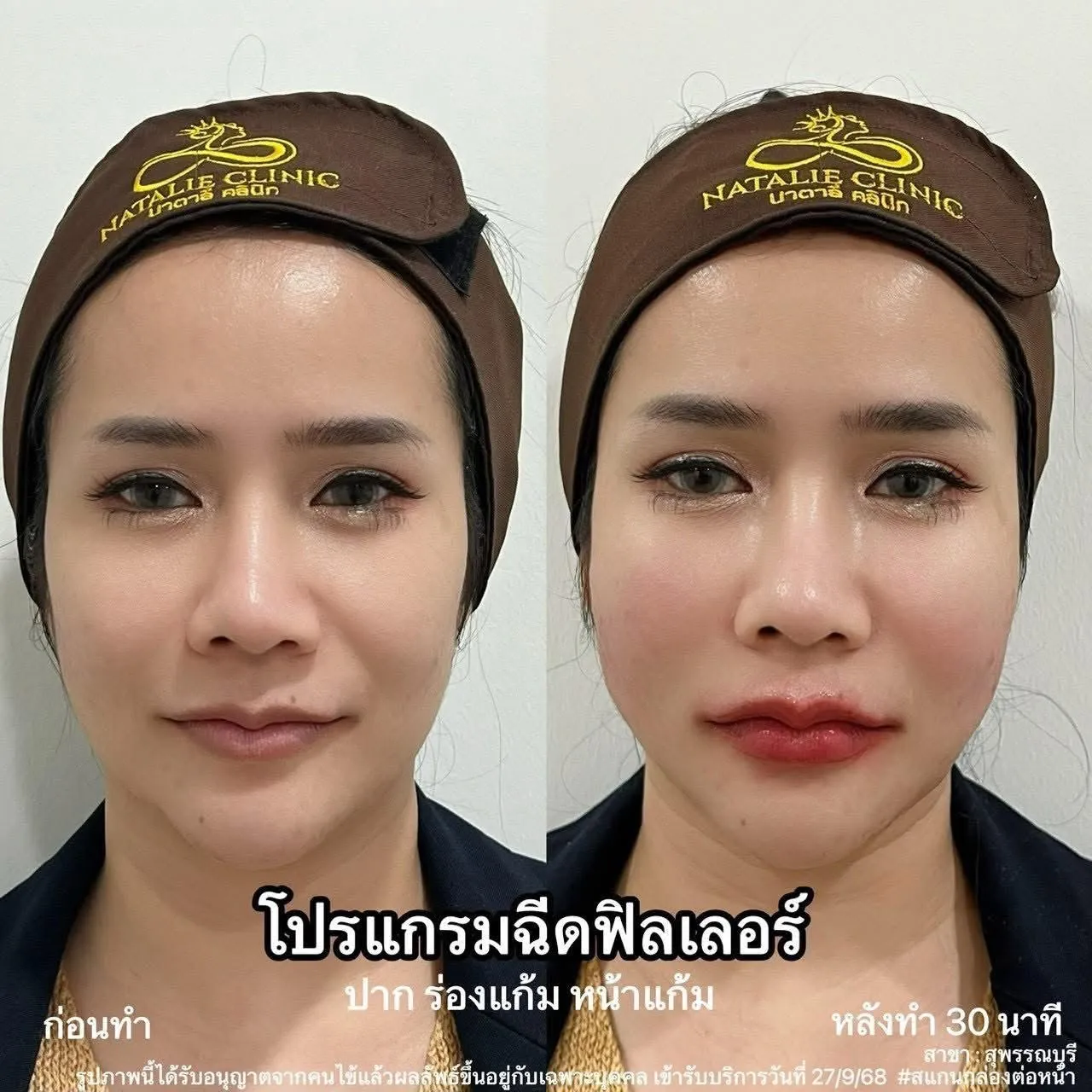 ฟิลเลอร์ ปาก ร่องแก้ม