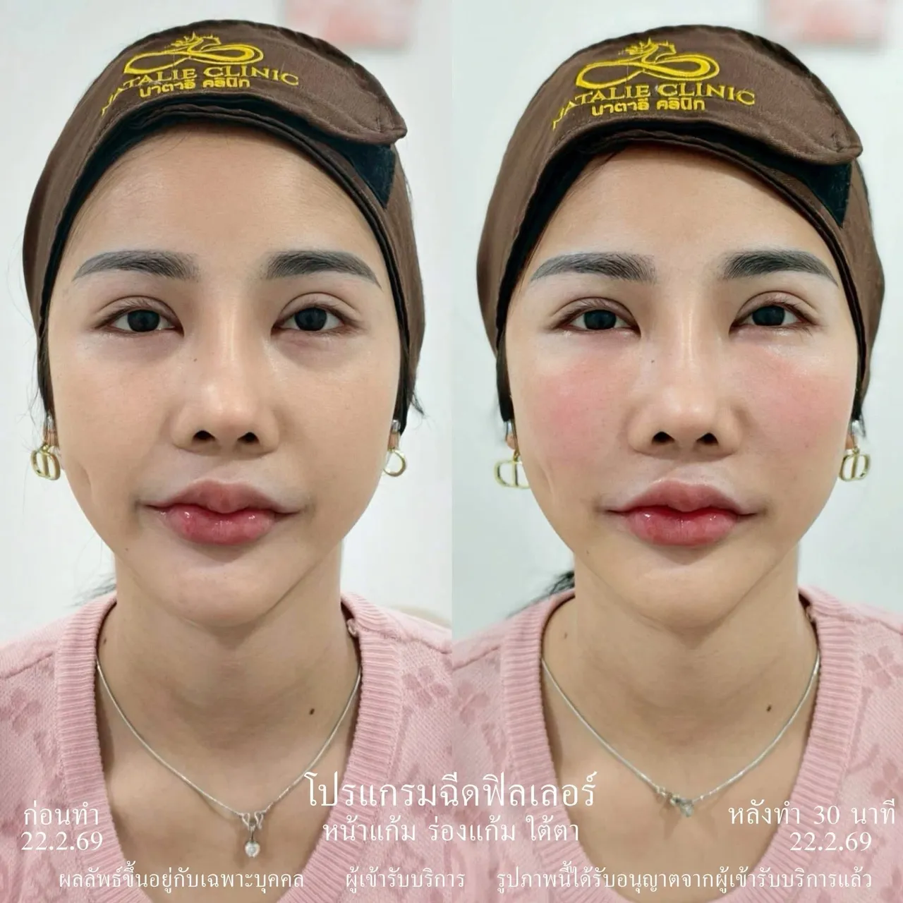 ฟิลเลอร์ หน้าแก้ม ใต้ตา