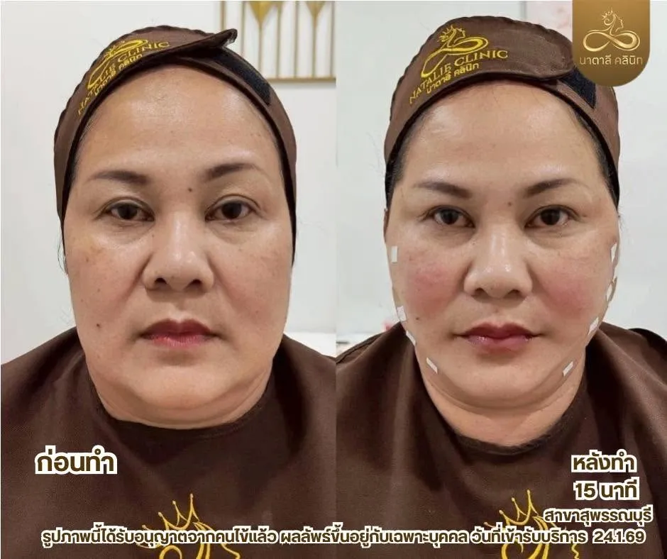 ร้อยไหมยกกระชับ