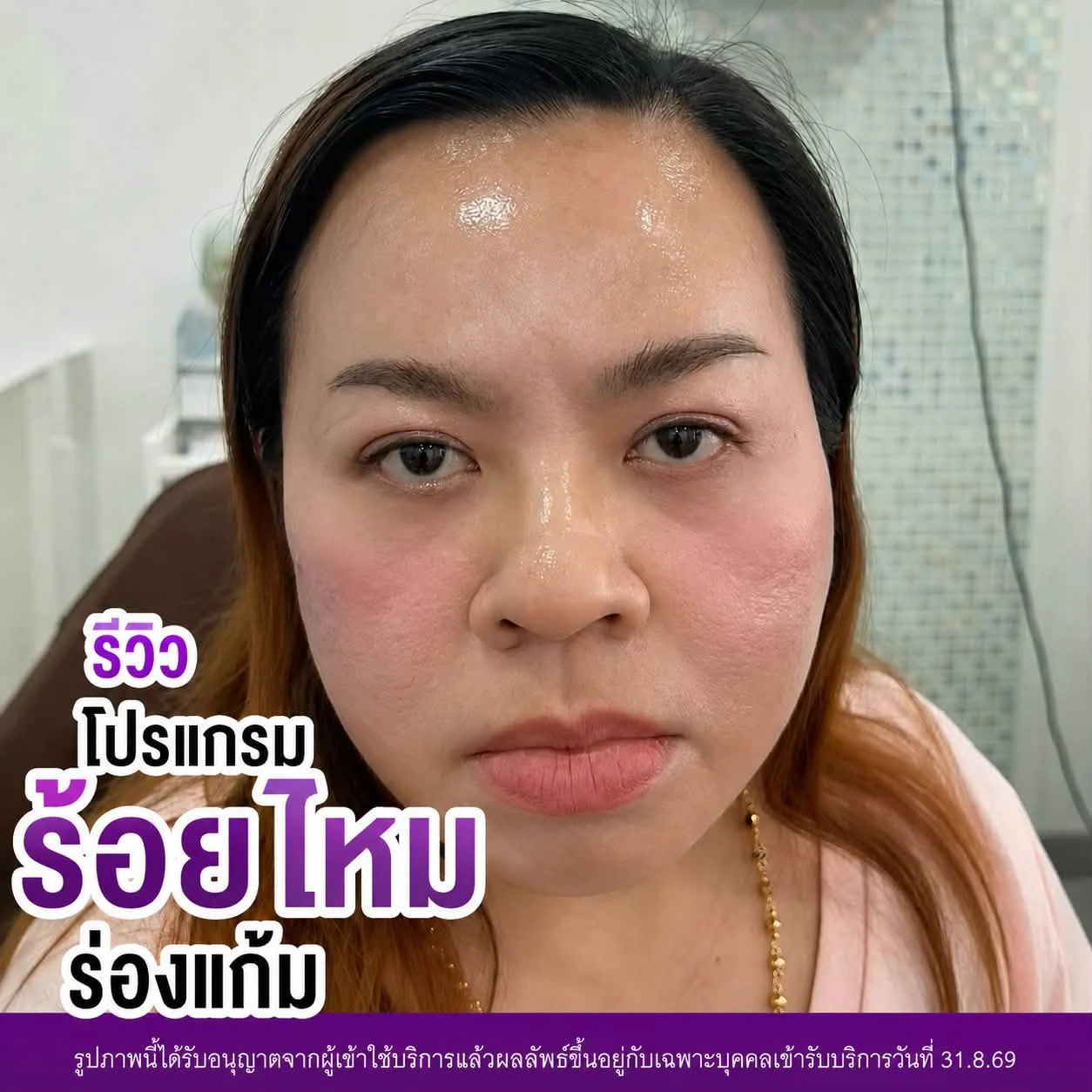 รีวิว โปรแกรมร้อยไหมร่องแก้ม · หลังทำ · มุมตรง