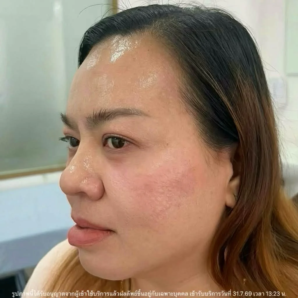 รีวิว โปรแกรมร้อยไหมร่องแก้ม · หลังทำ · มุมเฉียง