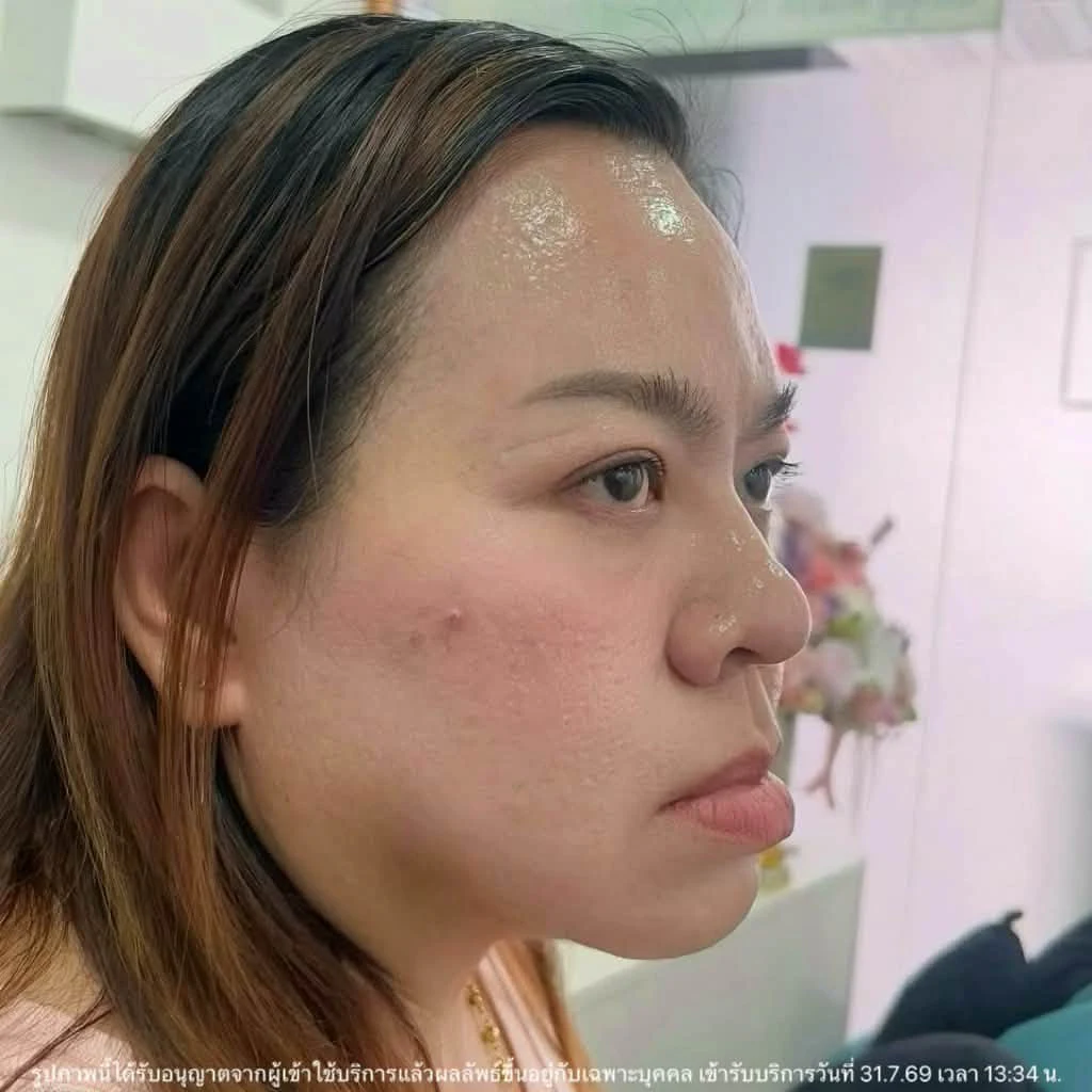 รีวิว โปรแกรมร้อยไหมร่องแก้ม · หลังทำ · มุมด้านข้าง