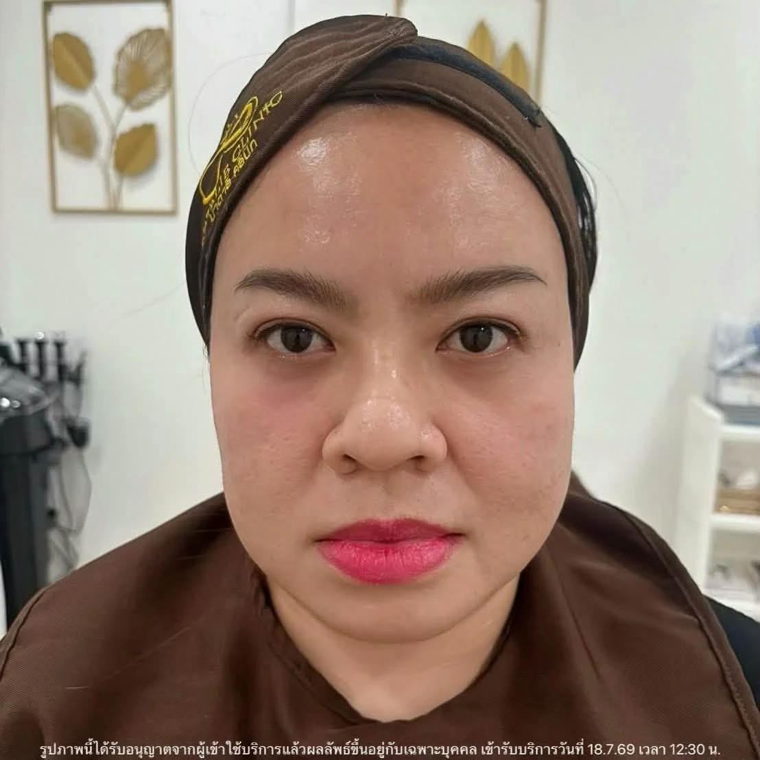 รีวิว โปรแกรมร้อยไหมร่องแก้ม · ก่อนทำ · มุมตรง