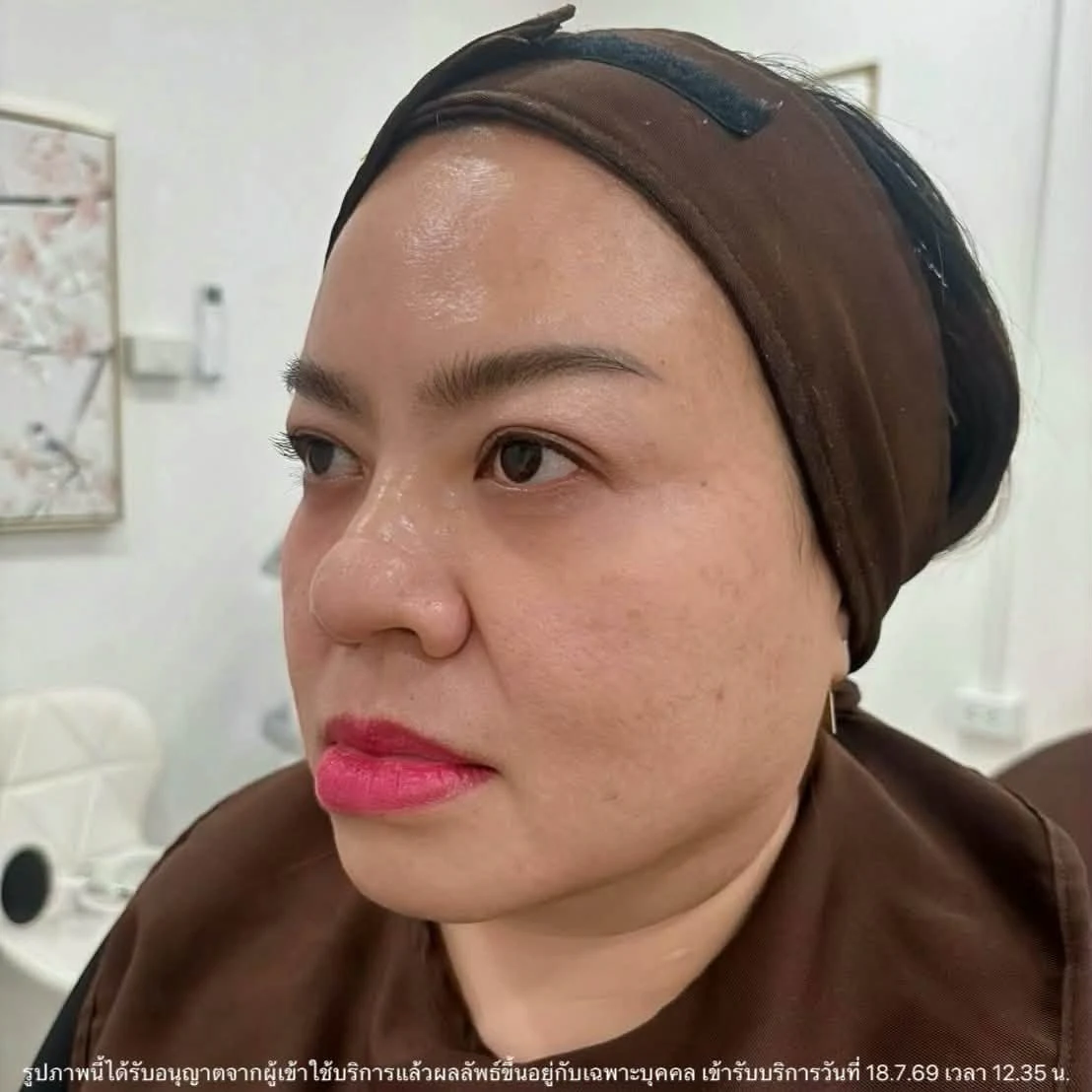 รีวิว โปรแกรมร้อยไหมร่องแก้ม · ก่อนทำ · มุมเฉียง