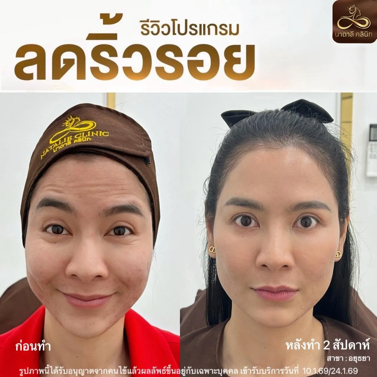 ลดริ้วรอย ปรับรูปหน้า