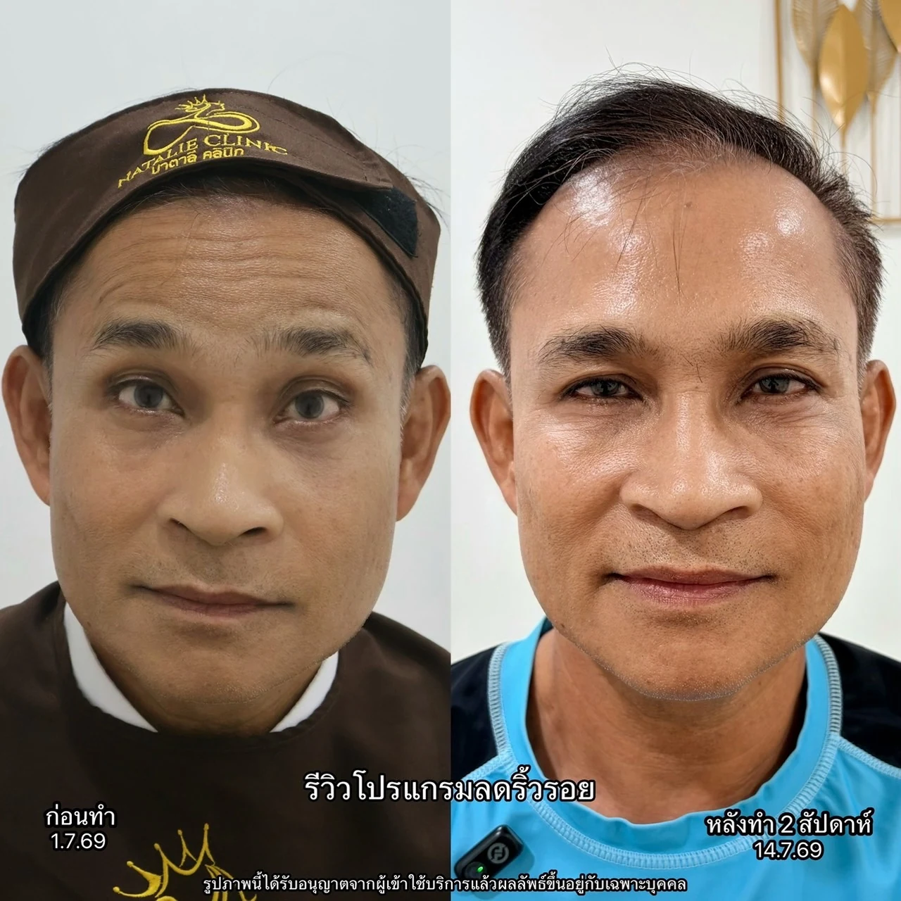 ลดริ้วรอย ก่อน–หลัง 2 สัปดาห์